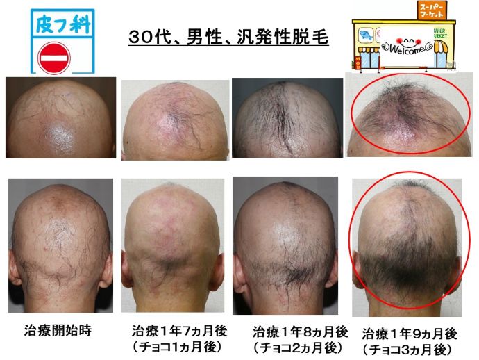 円形脱毛症　病院